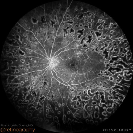 Diabetic macular edema