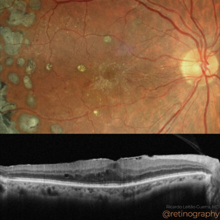 Diabetic retinopathy: ERM following PRP