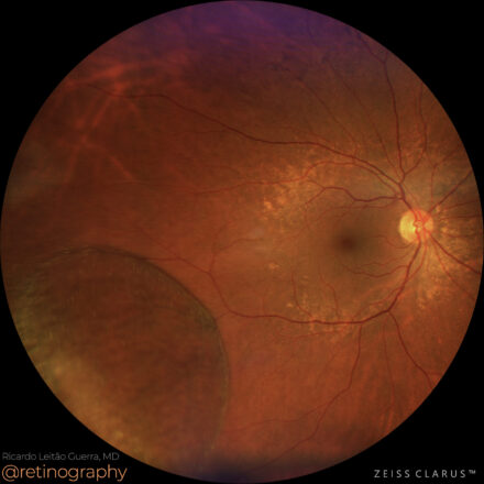 Peripheral retinoschisis