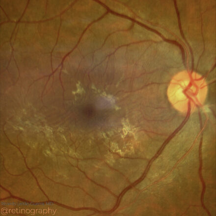 Epiretinal membrane