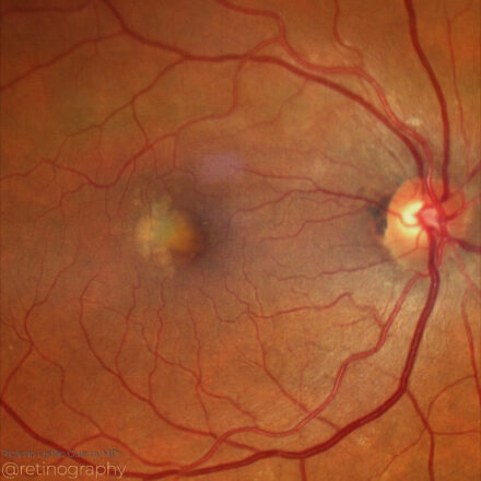 Acquired Vitelliform Lesion