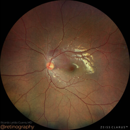 Choroidal rupture