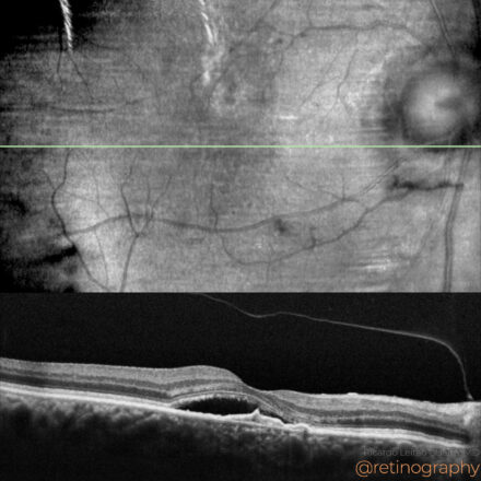 Polipoidal choroidal vasculopathy