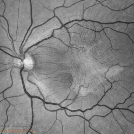 Epiretinal membrane