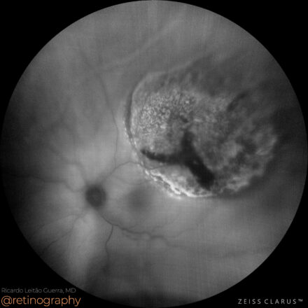 Choroidal melanoma