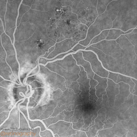 BRVO: Macula sparing