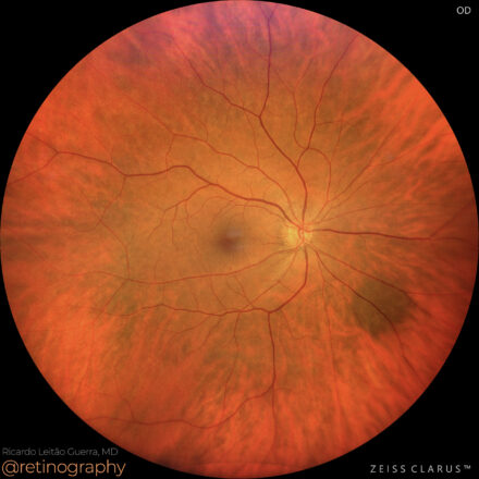 Choroidal nevus