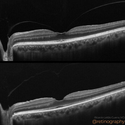 Vitreomacular traction: Spontaneous release