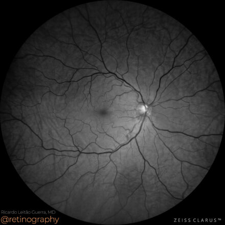 Choroidal folds: Hypotony