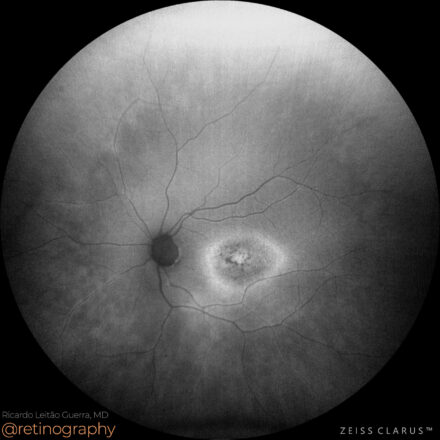 Presumed Cone Dystrophy