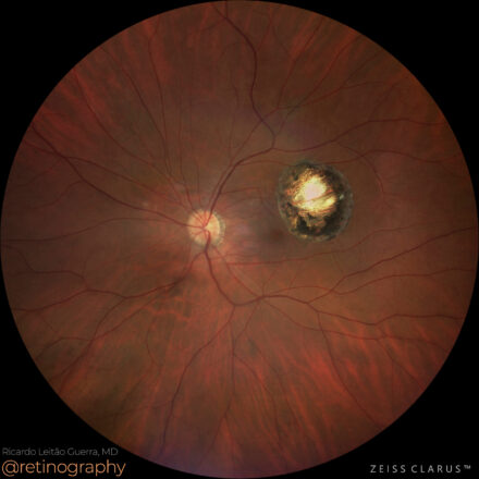 Ocular toxoplasmosis