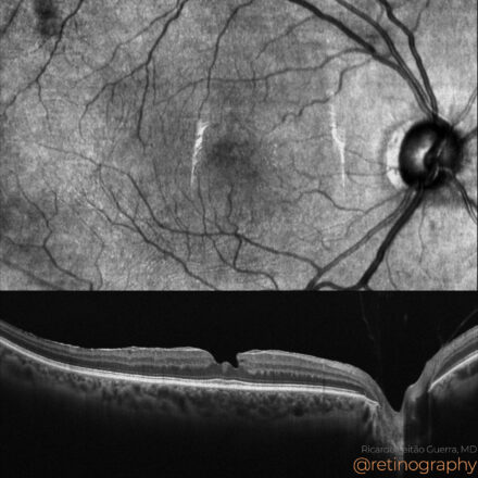 Lamellar Hole-Associated Epiretinal Proliferation,