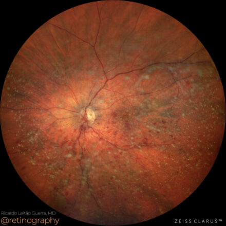 BRVO and asteroid hyalosis