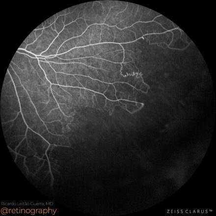 Sickle cell retinopathy