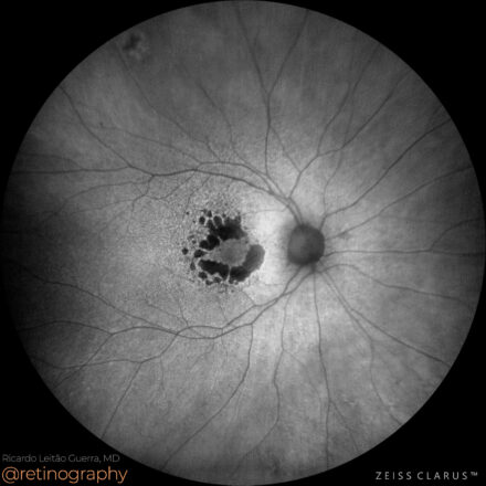 AMD: Geographic atrophy