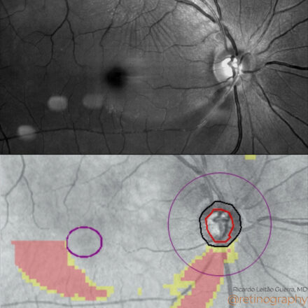 Glaucoma: RNFL deffect