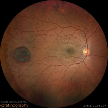 Congenital Hypertrophy of the Retinal Pigment Epithelium