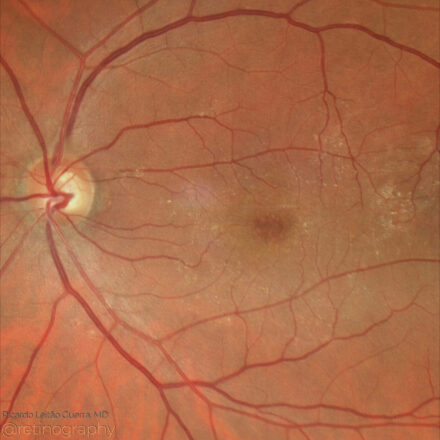 Lamellar Hole-Associated Epiretinal Proliferation