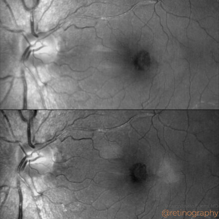 Macular telangiectasia type 2