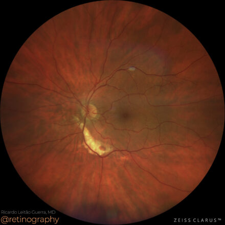 Sclopetaria chorioretinopathy