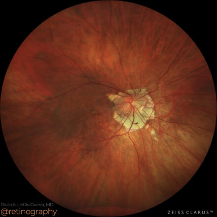 Myopic macular neovascularization