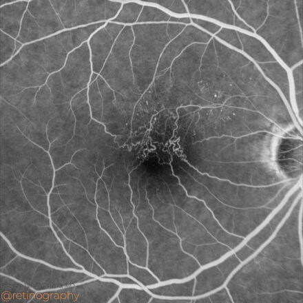 Secondary macular telangiectasia (BRVO)