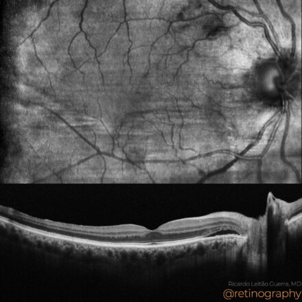 Polypoidal choroidal vasculopathy