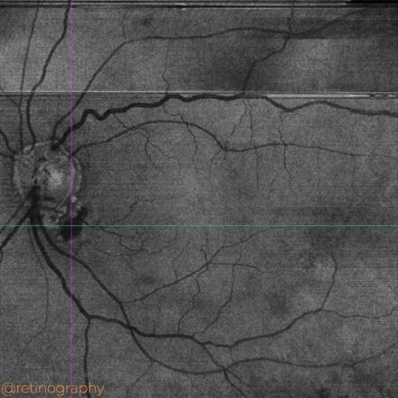 Polypoidal Choroidal Vasculopathy