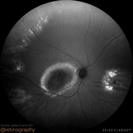 Multifocal Best’s vitelliform dystrophy