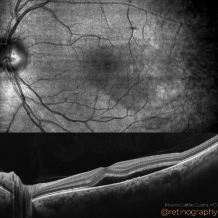 Central Serous Chorioretinopathy