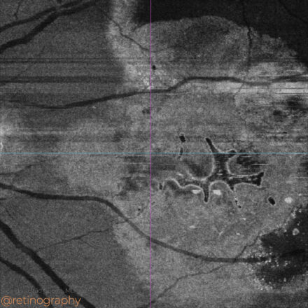 AMD: Outer retinal tubulations