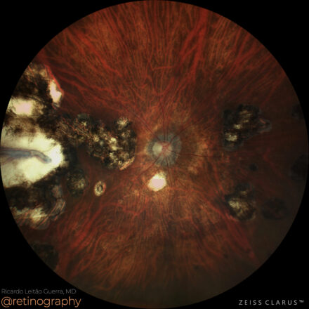 Ocular toxoplasmosis: Chorioretinitis scars