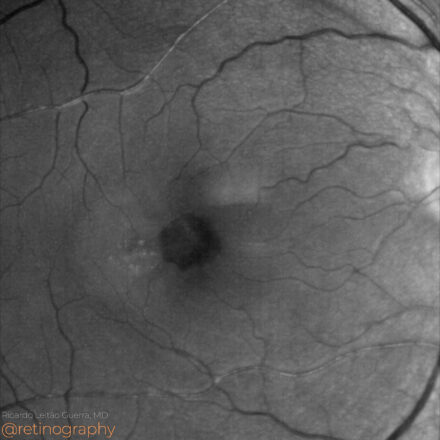 Macular telangiectasia type 2