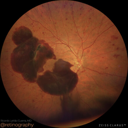 Proliferative Diabetic Retinopathy