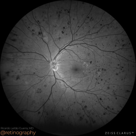 Sclopetaria chorioretinopathy – Retinography