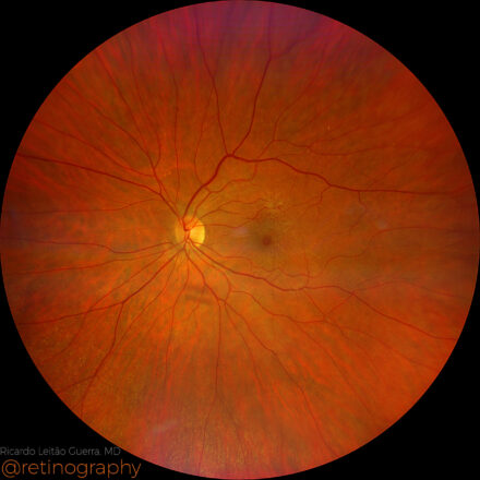Macular pseudohole
